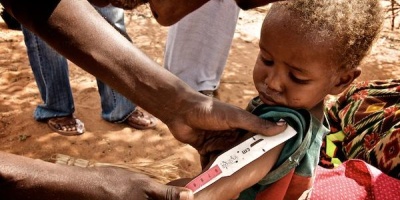 Photo: Colin Crowley, NEkenyaFB21|Young boy with lack of hair pigment due to protein deficiency during nutrition survey in Wajir District, Flickr, CC by 2.0